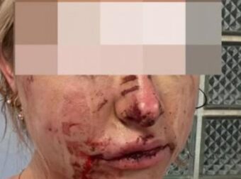 Απάνθρωπο περιστατικό! Ξυλοκόπησαν σύντροφο ποδοσφαιριστή – Ζητά πληροφορίες για την επίθεση